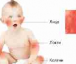 Как подобрать питание при пищевой аллергии у ребенка