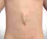 Что вы можете узнать о вентральной грыже на hernia.ru?